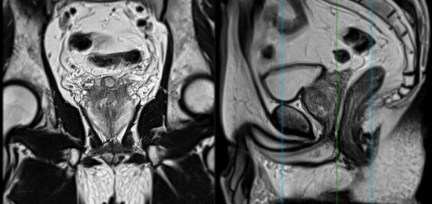 cancer de prostata
